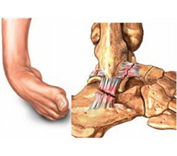 Leses Ligamentares