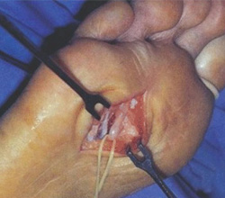 Neuroma de Morton