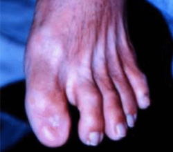 Pé de Charcot